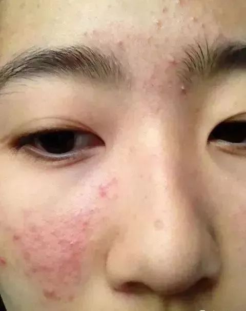 青春痘：我院就是你脸上的“小灯泡”，照亮你的青春_齐齐哈尔青春痘怎么治疗？_齐齐哈尔青春痘医院_齐齐哈尔皮肤病医院