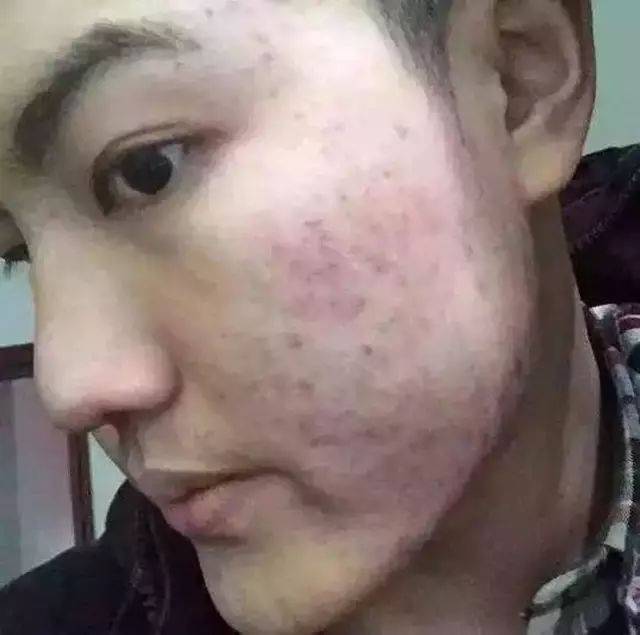 青春痘的“克星”：我的成功祛痘经验分享——五年青春痘患者自述_青春痘怎样才能祛除？_有没有彻底根治青春痘的办法？_齐齐哈尔青春痘医院_齐齐哈尔皮肤病医院