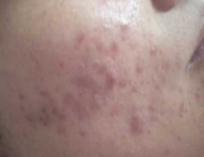 青春痘与遗传：父母有痘痘，孩子也会有吗？_ 痤疮会遗传吗？_齐齐哈尔青春痘医院_齐齐哈尔皮肤病医院