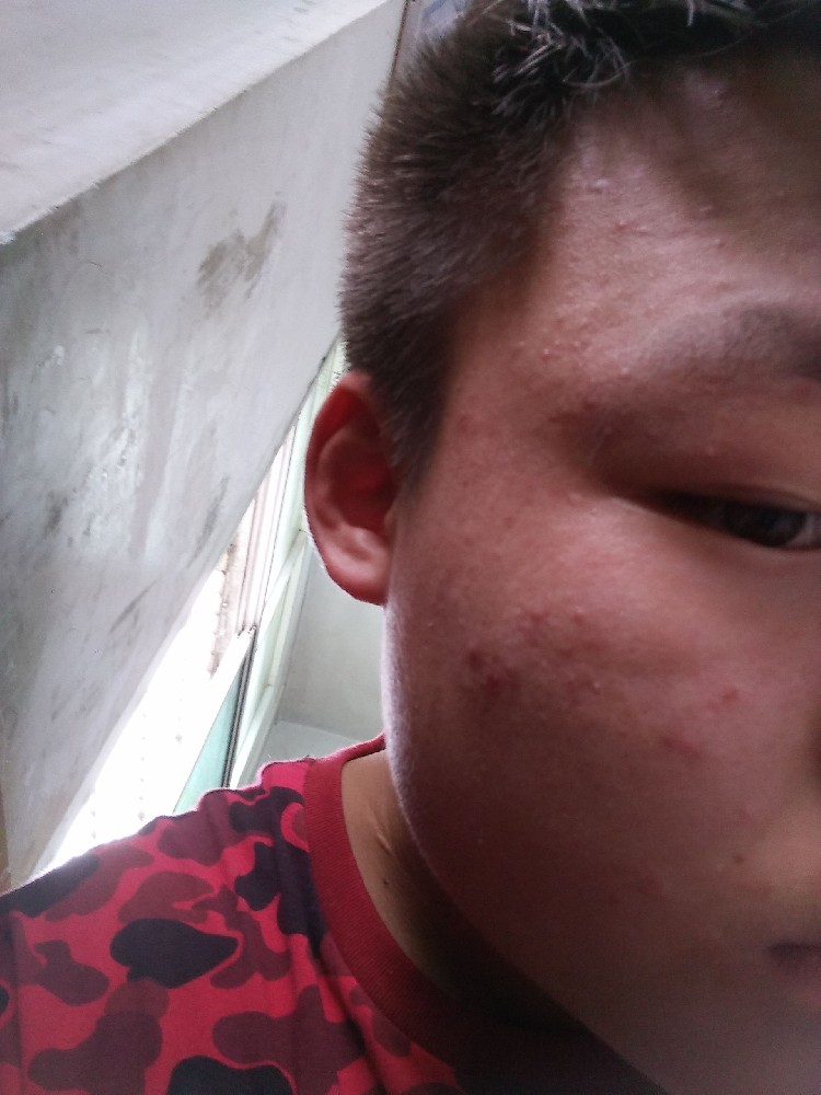 中国1.2亿成人痘患者：我们不是青春期，是“青春后期”