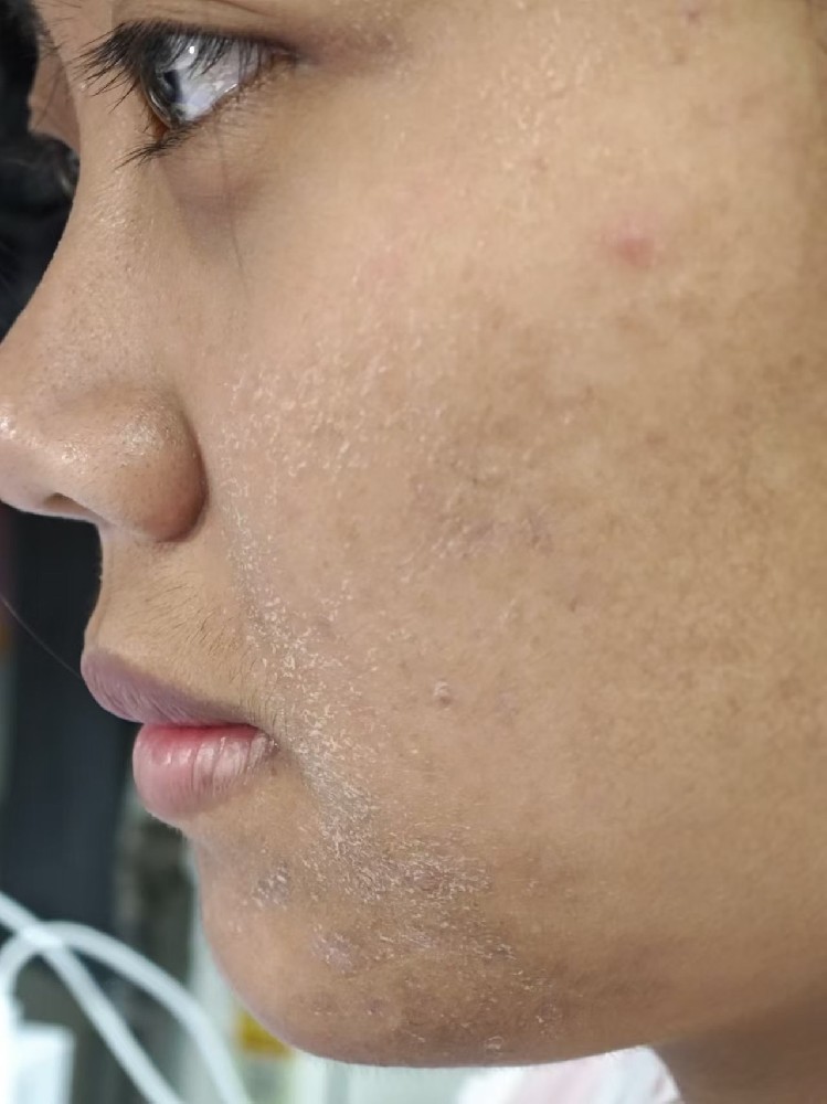 总是下巴长痘？雄激素、胰岛素与痤疮三角关系大揭秘