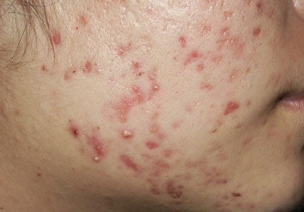 齐齐哈尔战“痘”指南：别让青春痘定义你的青春！——齐齐哈尔皮肤病医院